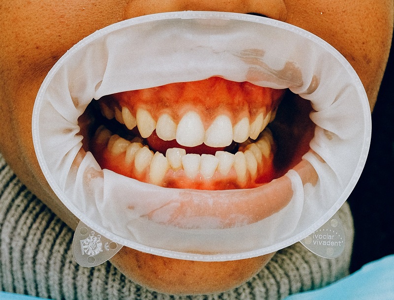 Do I Need Braces? Lansdowne Orthodontics